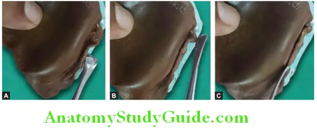 Fabrication of Denture Base Record Base adpting the reamining material into sulcus to record width and depth of sulcus