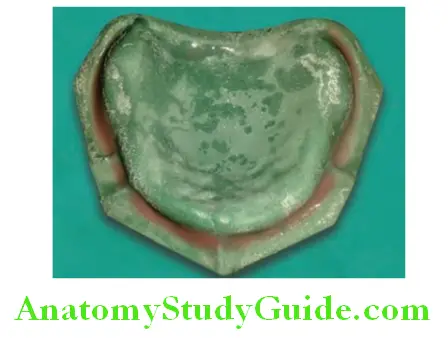 Fabrication of Denture Base Record Base making record base and recoding sulcus depth and width