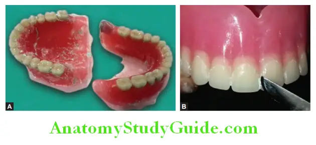 Finishing And Polishing Of Complete Denture remove mounting plaster from denture surface