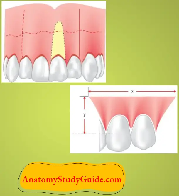 Flap Designs And Incisions