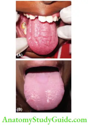 General And Local Examination (A) Macroglossia Seen In Down's Syndrome (B) Fleeting Type Of Tonuge Depapillation Begin Migratory Glossitis