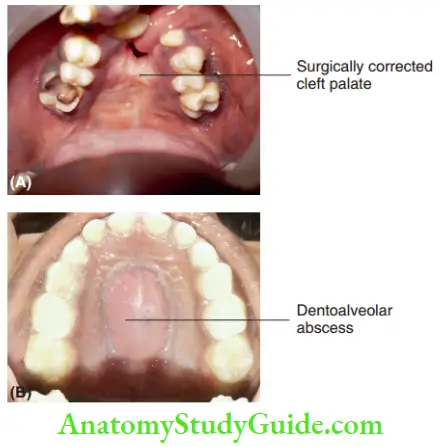 General And Local Examination (A) Surgically Corrected Cleft Palate With Residual Cleft (B) Palatal Dentoalveloar Abscess