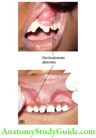 General And Local Examination Dentoalveloar Abscess On Labial Mucosa