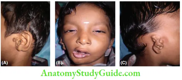 General And Local Examination Malformation Of The External Ear Associated With Craniofacial Anomalies In A 7 Year Old Baby