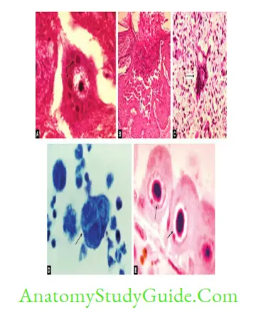 General Properties Of Viruses Notes Viral inclusion bodies. A. Negri body (Rabies) B. Molluscum body (Molluscum contagiosum virus infection)