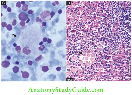 Genetic And Paediatric Diseases Gaucher Cell In Bone Marrow Aspirate Smear And Infiltration Red Pulp Of Splenic