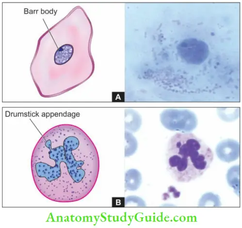 Genetic And Paediatric Diseases Nuclear Sxing Barr Body And drumstick Appendage