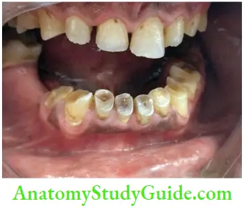 Geriatric Endodontics Attrition Of teeth Resulting In Multiple Pulp Exposure