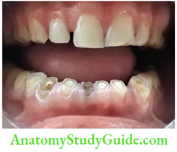 Geriatric Endodontics Photograph Showing Attrition Of Mandibular Anterior Teeth Resulting In Pulp Exposure