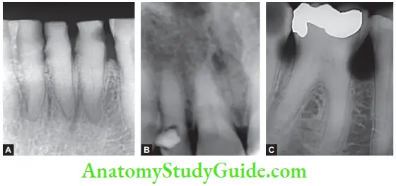 Geriatric Endodontics Radiograph Of Mandibular Incisors, Maxillary lateral Incisor, Mandibular First Molar Showing Narrow And Calcified Canals