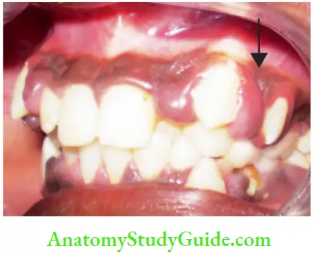 Gingival Involvement In Children Cobined Enlargement Of The Gingiva Due To Secondary Plaque Accumulation In The Pseudo-pockets Of Drug Induced Gingival Enlargement