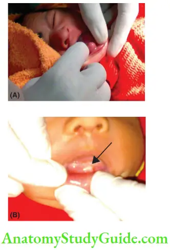 Gingival Involvement In Children Congenital Giant Cell Epulis In A 23-Hour-Old Newborn Female Baby