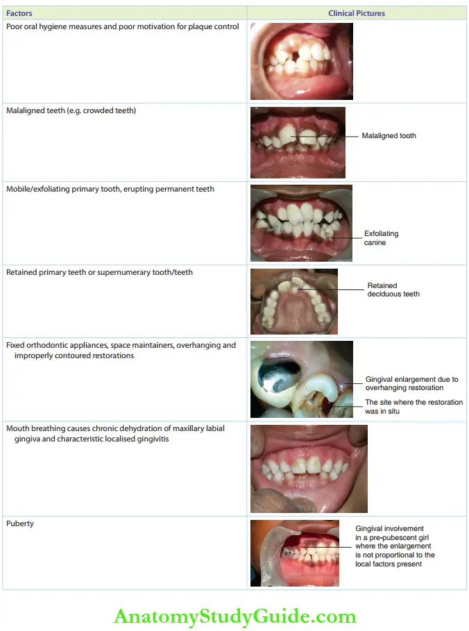 Gingival Involvement In Children Factors That Predispose A Child To Gingivitis With Illustrated Clinical Examples