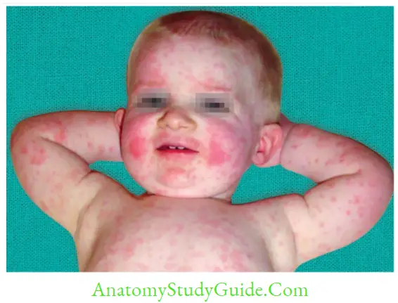 Herpesviruses And Other DNA Viruses Fifth disease or rashes with slapped cheek appearance