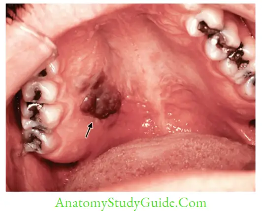 Herpesviruses And Other DNA Viruses Kaposi’s sarcoma of the hard palate secondary to AIDS infection (arrow showing)