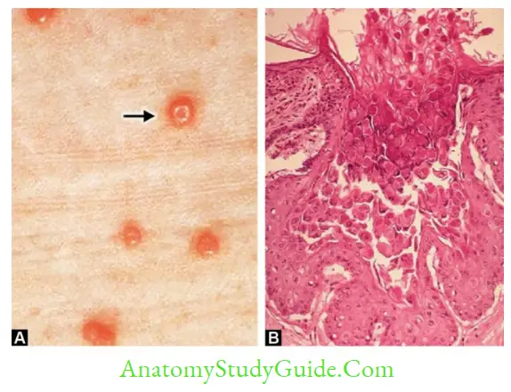 Herpesviruses And Other DNA Viruses Molluscum contagiosum lesions on skin; B. Histopathology of skin showing molluscum bodies