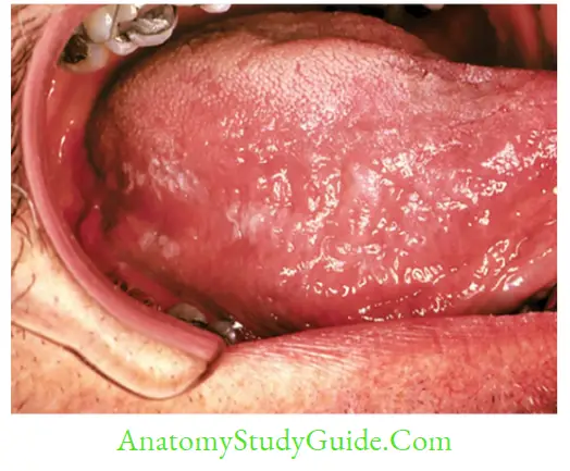 Herpesviruses And Other DNA Viruses Oral hairy leukoplakia of the tongue