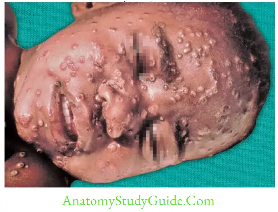 Herpesviruses And Other DNA Viruses Smallpox rashes over the face