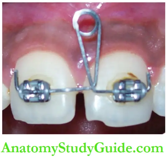 Interceptive Orthodontics A spring fabricated using a rectangular wire on edgewise brackets