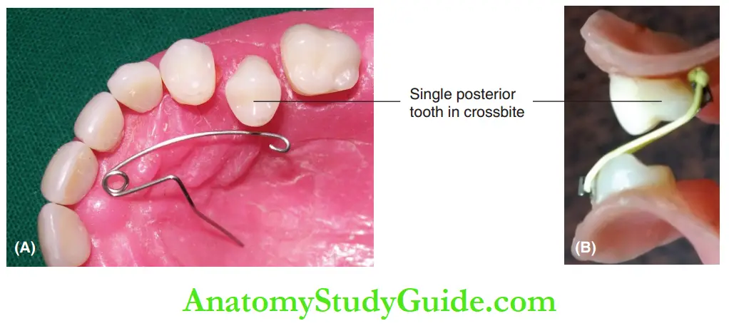 Interceptive Orthodontics Appliances indicated to correct single tooth posterior crossbite