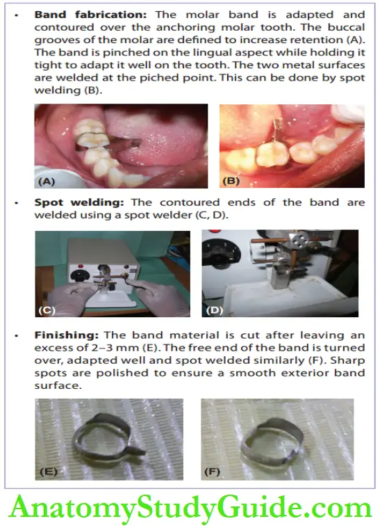 Interceptive Orthodontics Band Fabrication