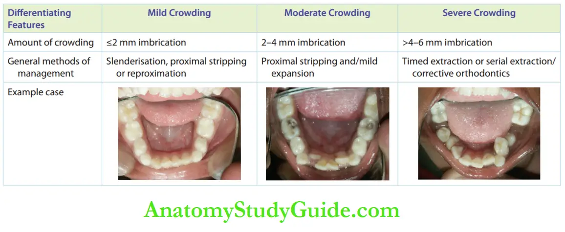 Interceptive Orthodontics Comparison of Diffrent Situations of Crowding and Appropriate Management Techniques