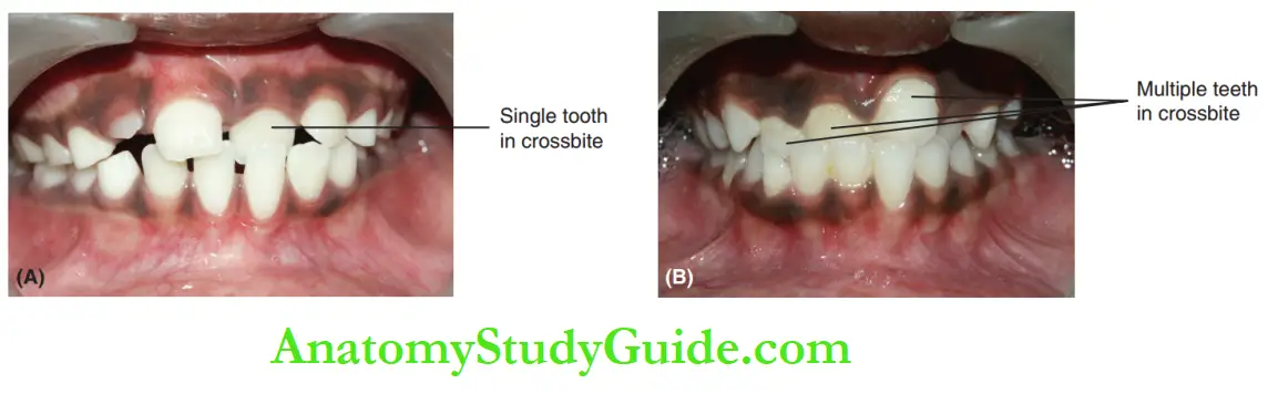 Interceptive Orthodontics Dental anterior crossbite