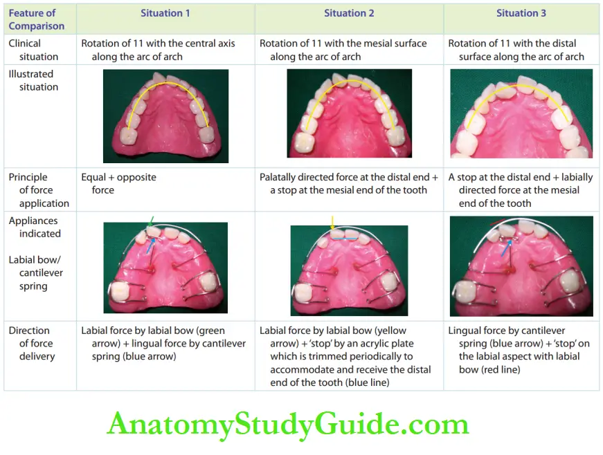 Interceptive Orthodontics Diffrent Cases of Tooth Rotation and Appropriate Management