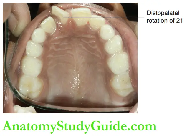 Interceptive Orthodontics Distopalatal rotation of 21