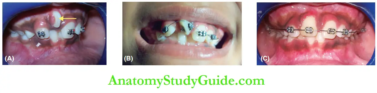 Interceptive Orthodontics Management of abnormally erupted right maxillary central incisor.