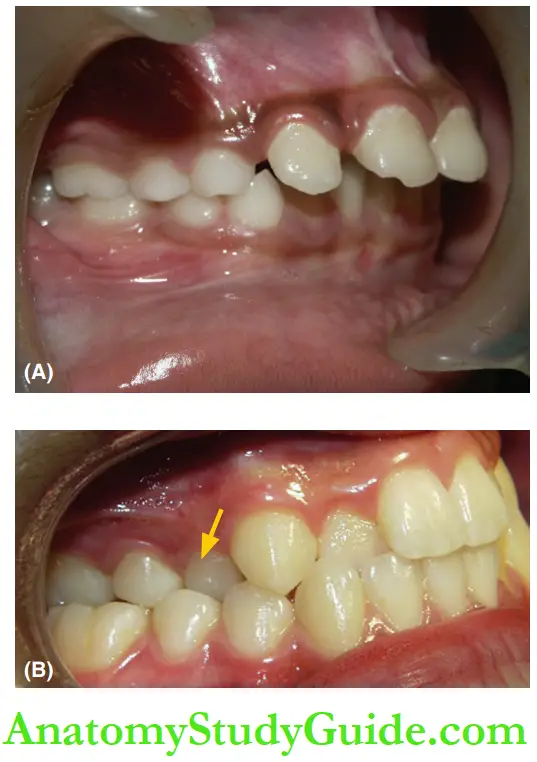 Interceptive Orthodontics Normal posterior occlusion