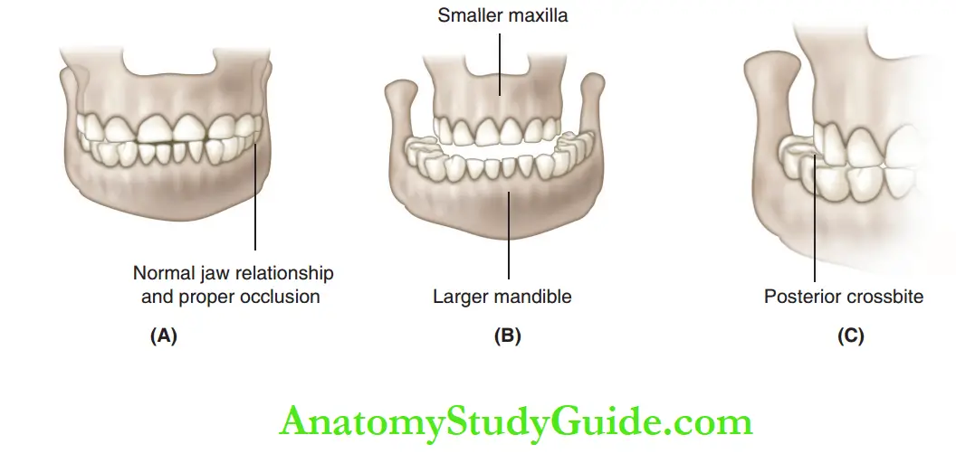 Interceptive Orthodontics Treatment options for class III skeletal condition