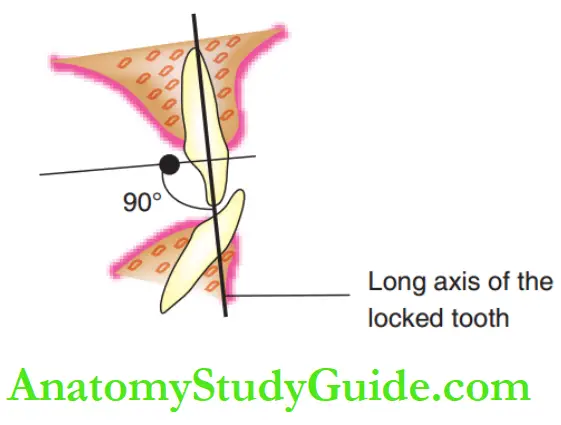 Interceptive Orthodontics Push type of force exerted with springs perpendicular to the long axis of the tooth