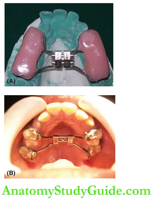 Interceptive Orthodontics Rapid maxillary expansion with Hyrax screw.