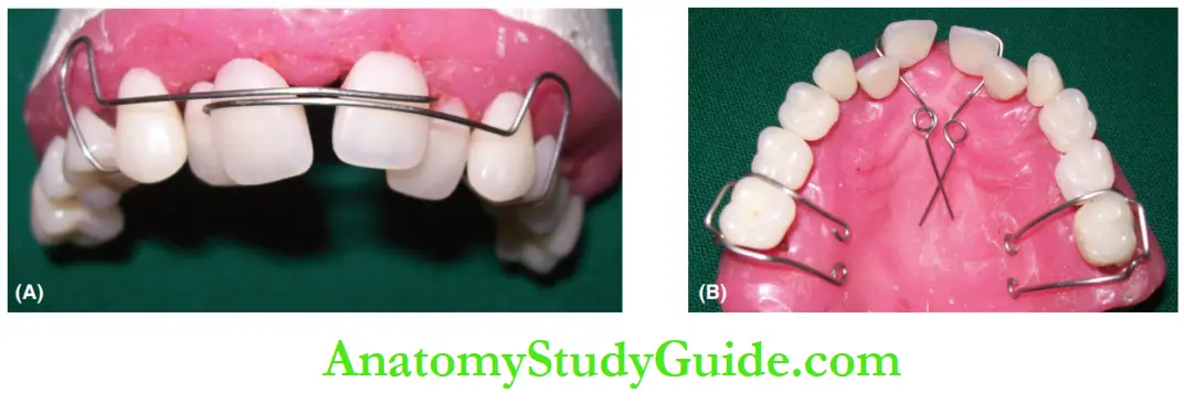 Interceptive Orthodontics Removable appliance for correction of median diastema.