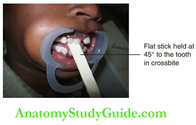 Interceptive Orthodontics Tongue blade therapy