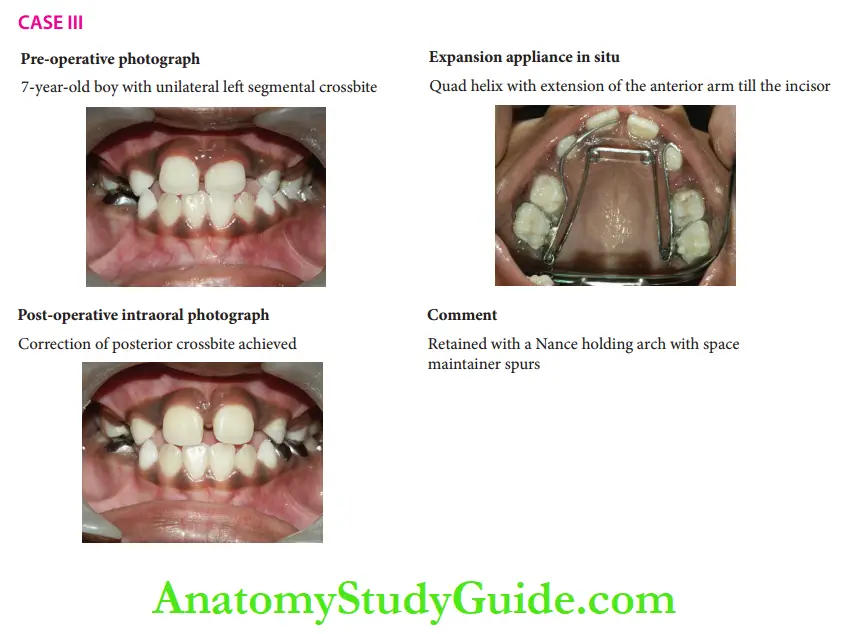 Interceptive Orthodontics case descripition 2