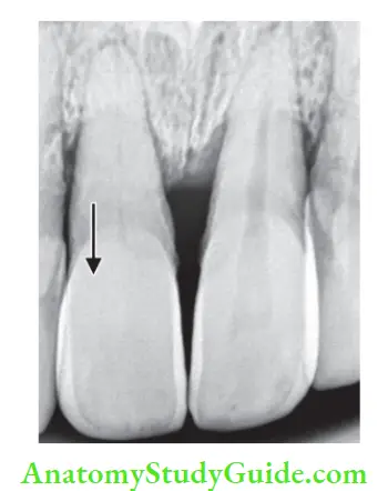 Internal Anatomy Calcifi metamorphosis of right maxillary central incisor showing radiopacity of pulp space.