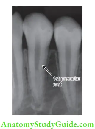 Internal Anatomy In mandibular 1st premolar, single root splits into two, giving letter “h” appearance.