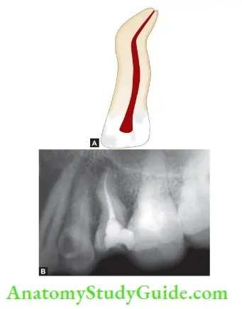 Internal Anatomy Line diagram showing bayonet-shaped canal; radiograph showing bayonet shaped maxillary second premolar.