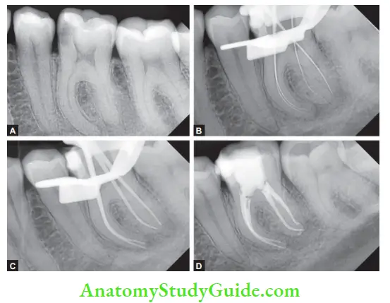 Internal Anatomy Management of irreversible pulpitis in Mandibular 1st molar with Radix entomolaris