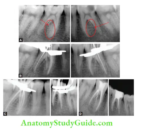 Internal Anatomy Management of irreversible pulpitis in Mandibular Left and right fist molars (36 and 46) with radix entomolaris.