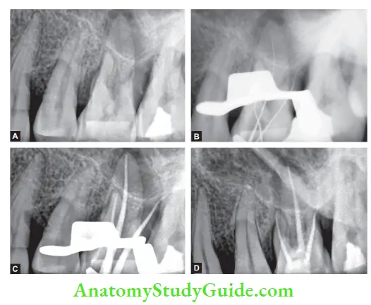 Internal Anatomy Management of irreversible pulpitis in maxillary fist molars