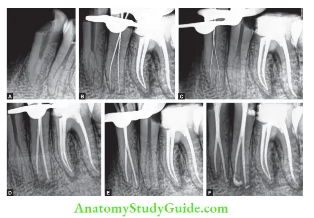 Internal Anatomy Management of mandibular 1st and 2nd premolars with bifurcation of canals