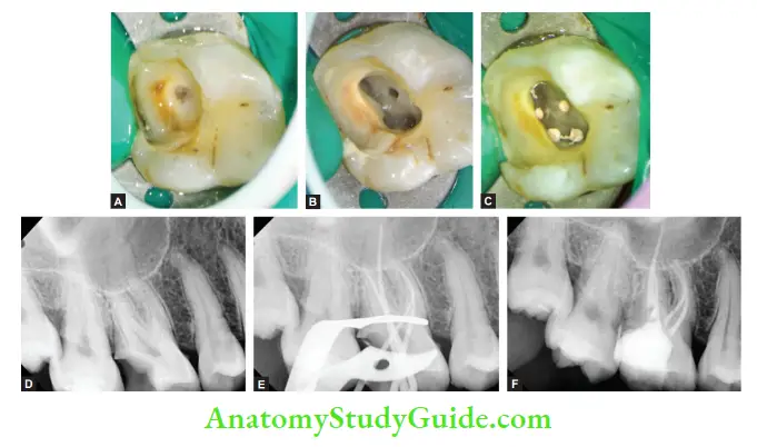 Internal Anatomy Management of maxillary fist molar with four canals