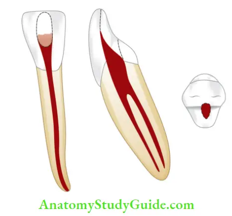 Internal Anatomy Mandibular lateral incisor.
