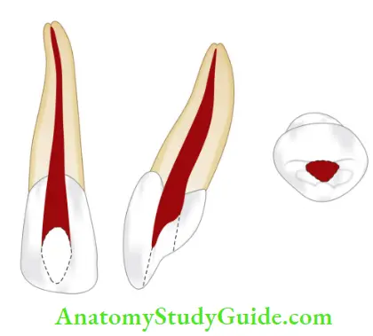 Internal Anatomy Maxillary lateral incisor.