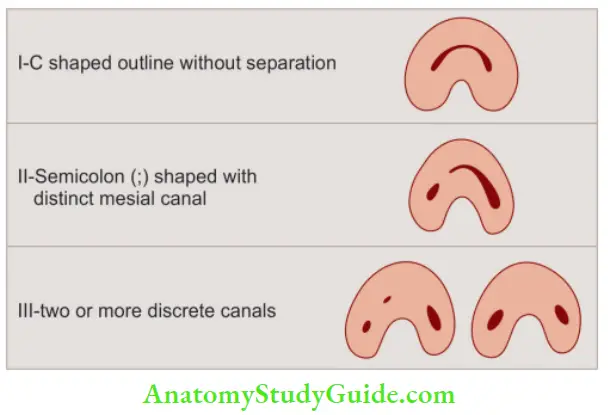 Internal Anatomy Melton’s classifiation of C shaped canals.