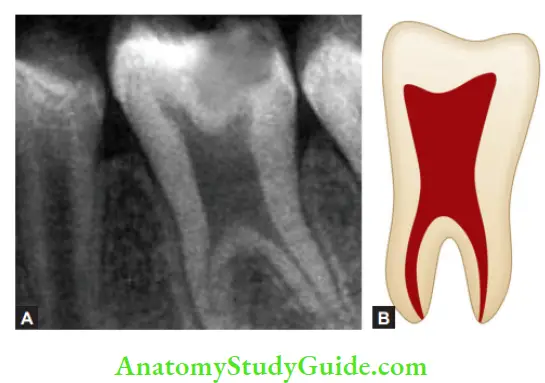 Internal Anatomy Taurodontism showing large pulp chamber with greater apico-occlusal height in; Radiograph of mandibular 1st molar; Schematic representation.