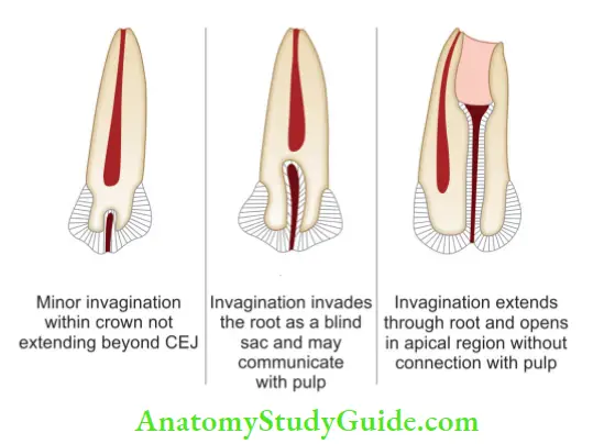 Internal Anatomy Types of dens invaginatus.
